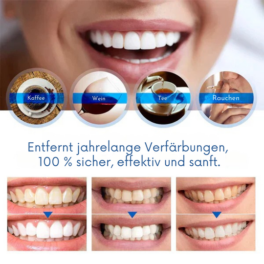 PerfectSmile™ Zahnaufhellungsstift: Für ein strahlendes Lächeln